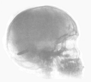 Skull Xray Skull Xray